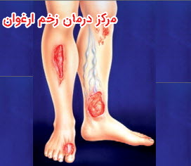 زخم پای واریسی