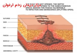 عفونت زخم پس از عمل
