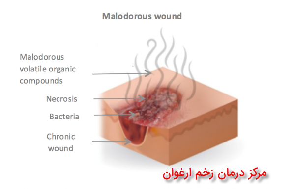 زخم های عفونی